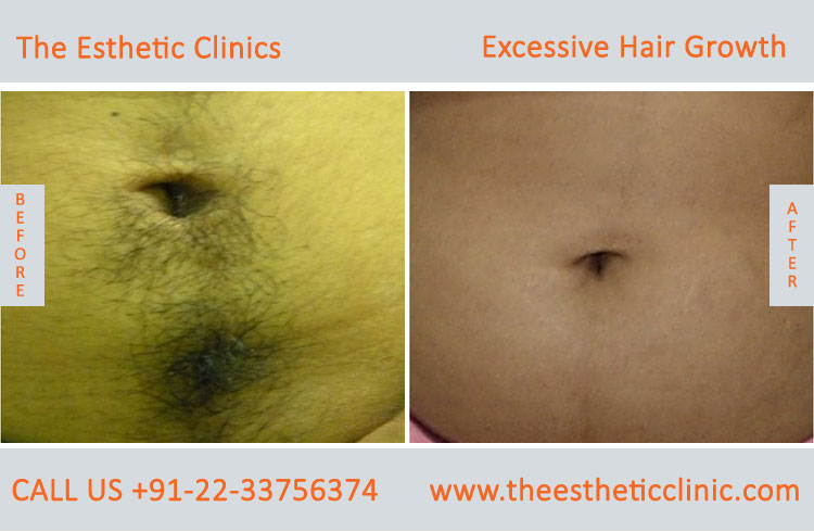 Excessive Hair Growth Removal Treatment before after photos in mumbai india (12)